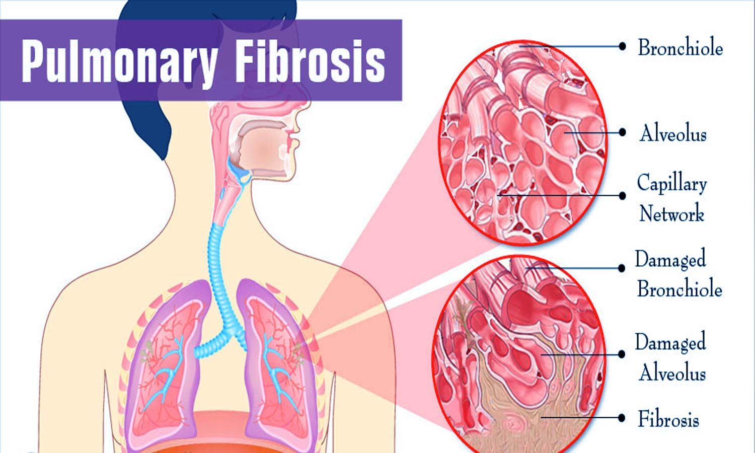 Lung fibrosis