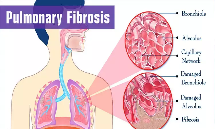 Pirfenidone found safe, efficacious in idiopathic pulmonary fibrosis