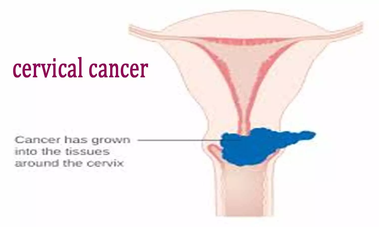 Open surgery superior to minimally invasive surgery for early cervical cancer