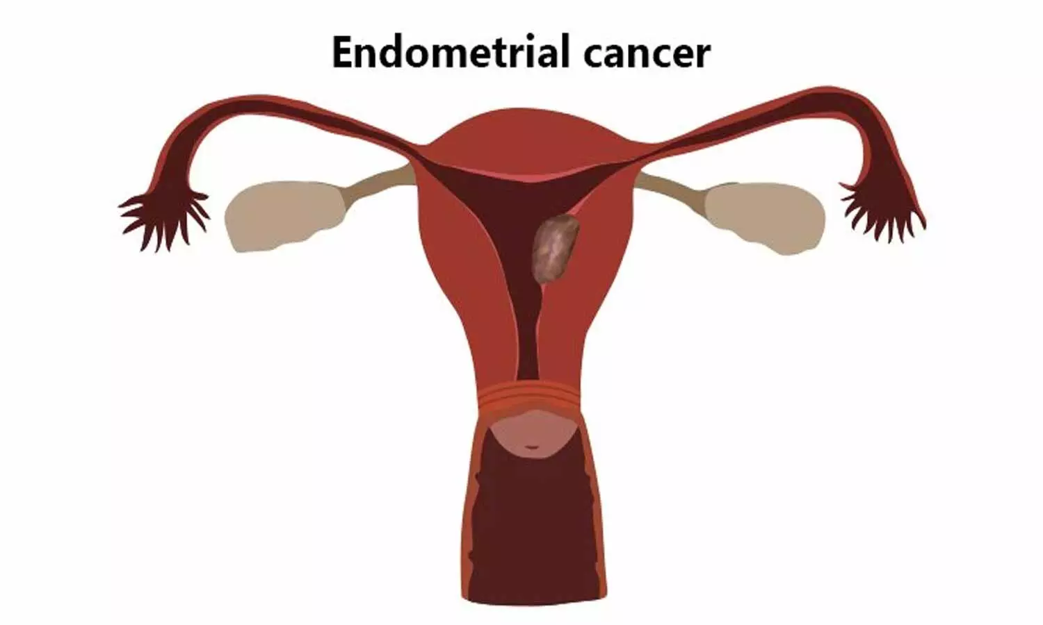 Adiposity tied to increased progression of endometrial cancer, study finds