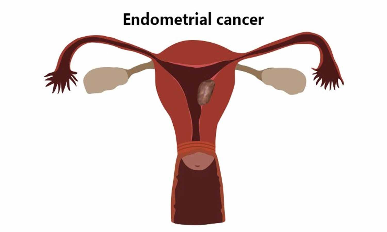 ppt-endometrial-cancer-powerpoint-presentation-free-download-id-221956