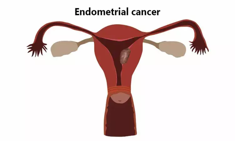 Immunotherapy drug shows promise in advanced endometrial cancer