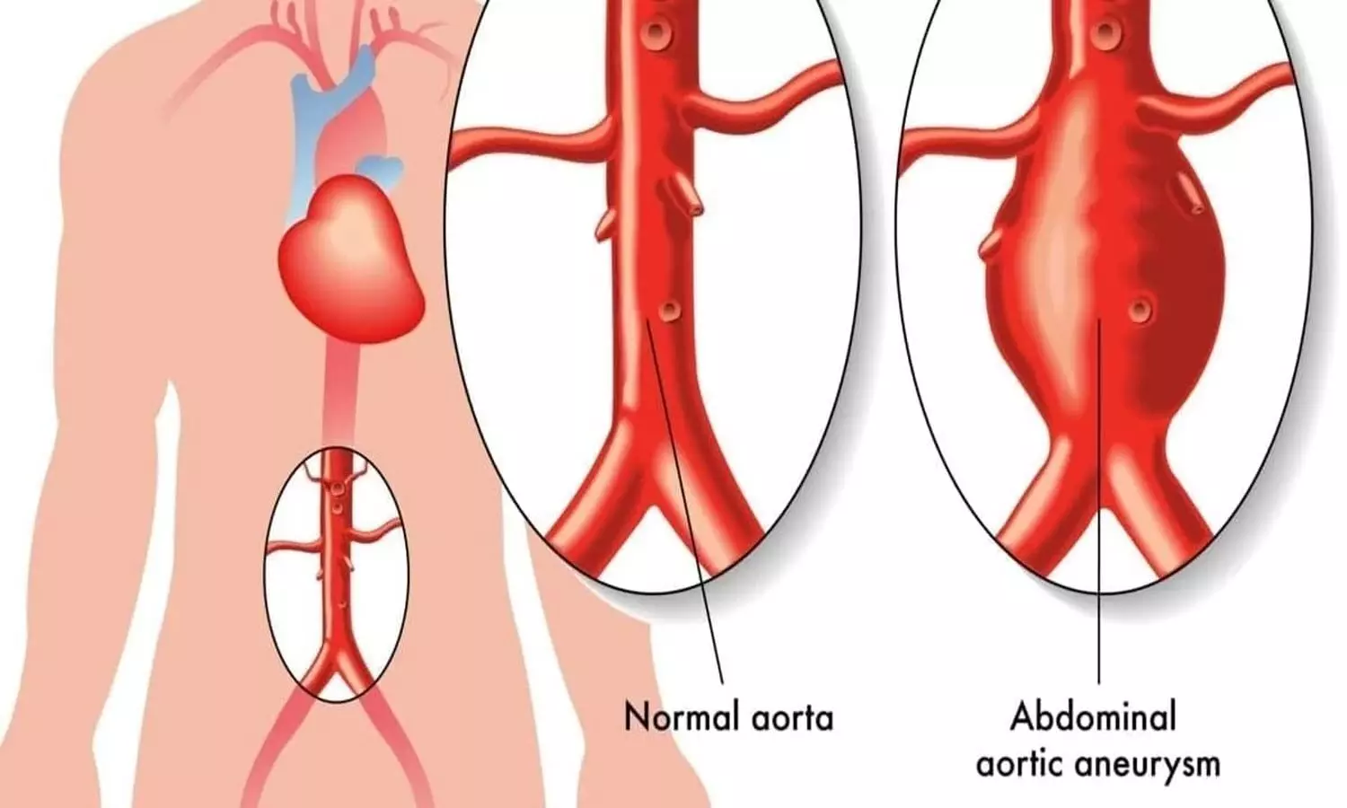 Overall mortality with endovascular  Abdominal Aortic Aneurysm Repair higher compared to Open surgery