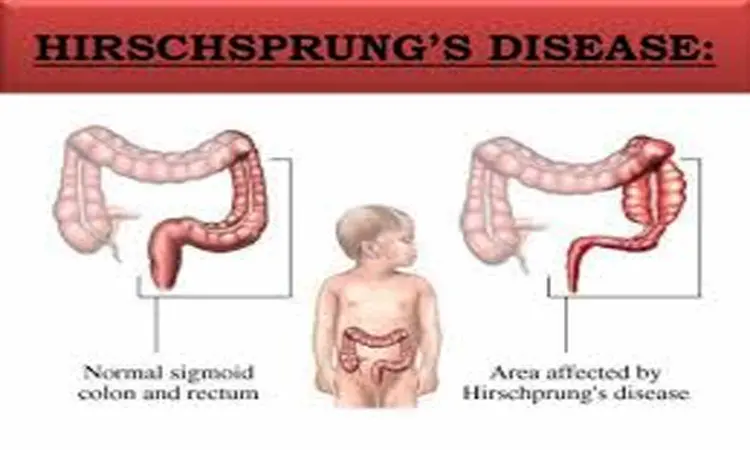 Preclinical study offers hope for patients of Hirschsprungs disease