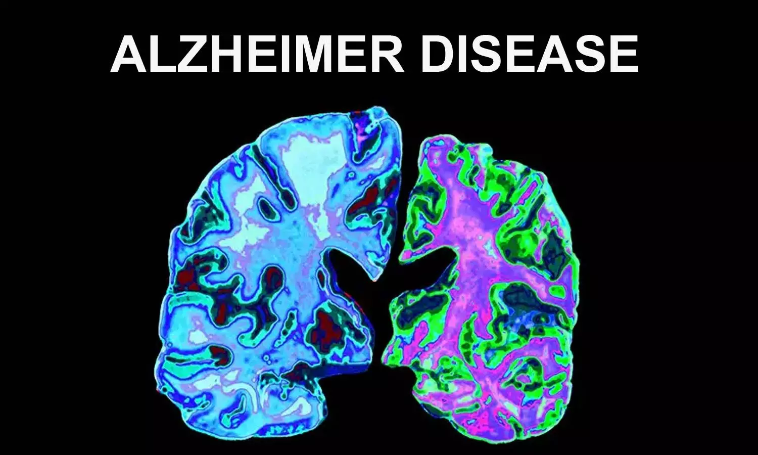 Possible new PET tracer for early detection of Alzheimers disease