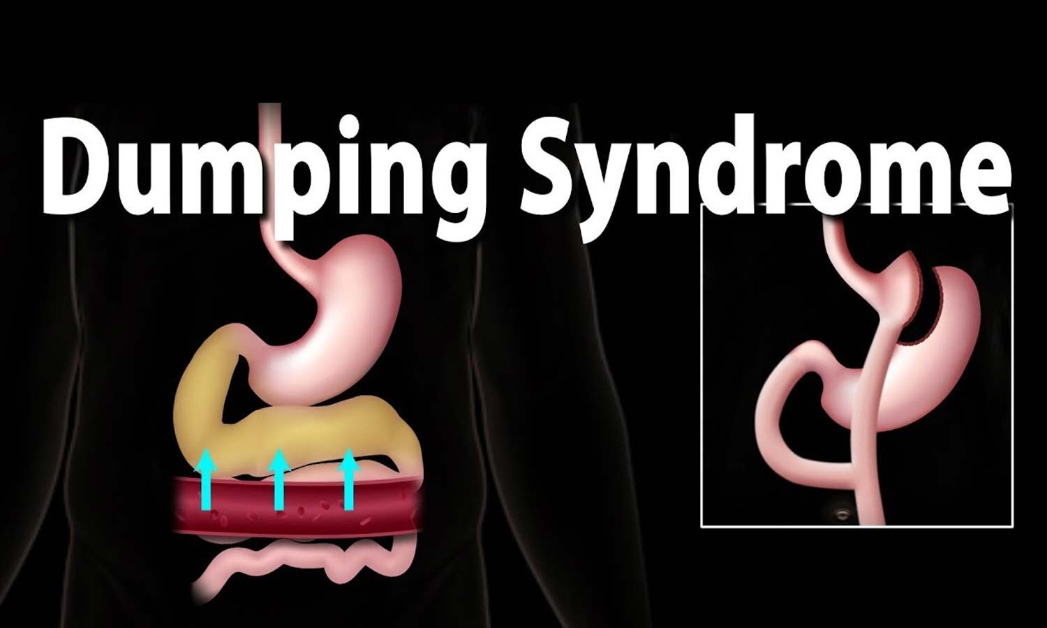 What Condition Is Associated With Dumping Syndrome Quizlet