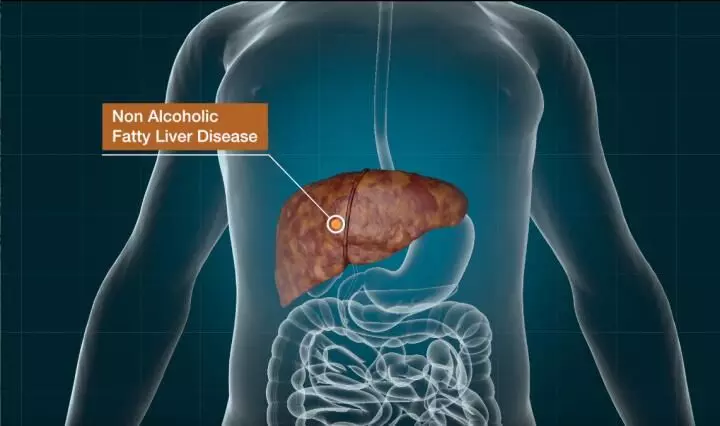 Severe vitamin D deficiency linked to fatty liver: Study