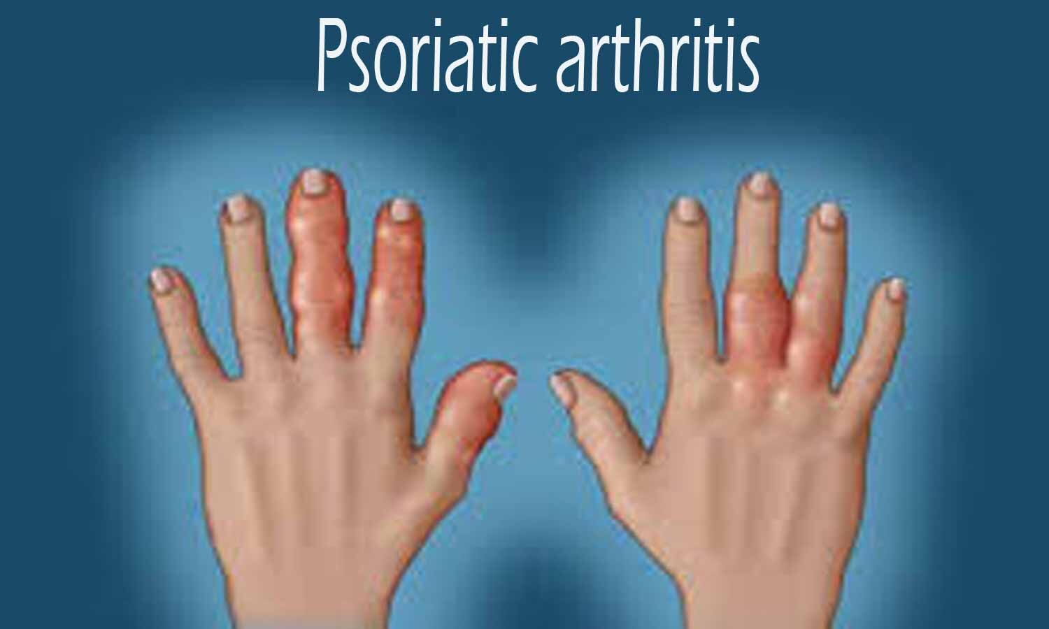 Псориазный ревматоидный артрит
