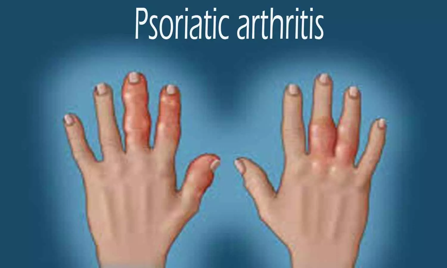 Tofacitinib may benefit Psoriatic Arthritis patients as monotherapy: LANCET study