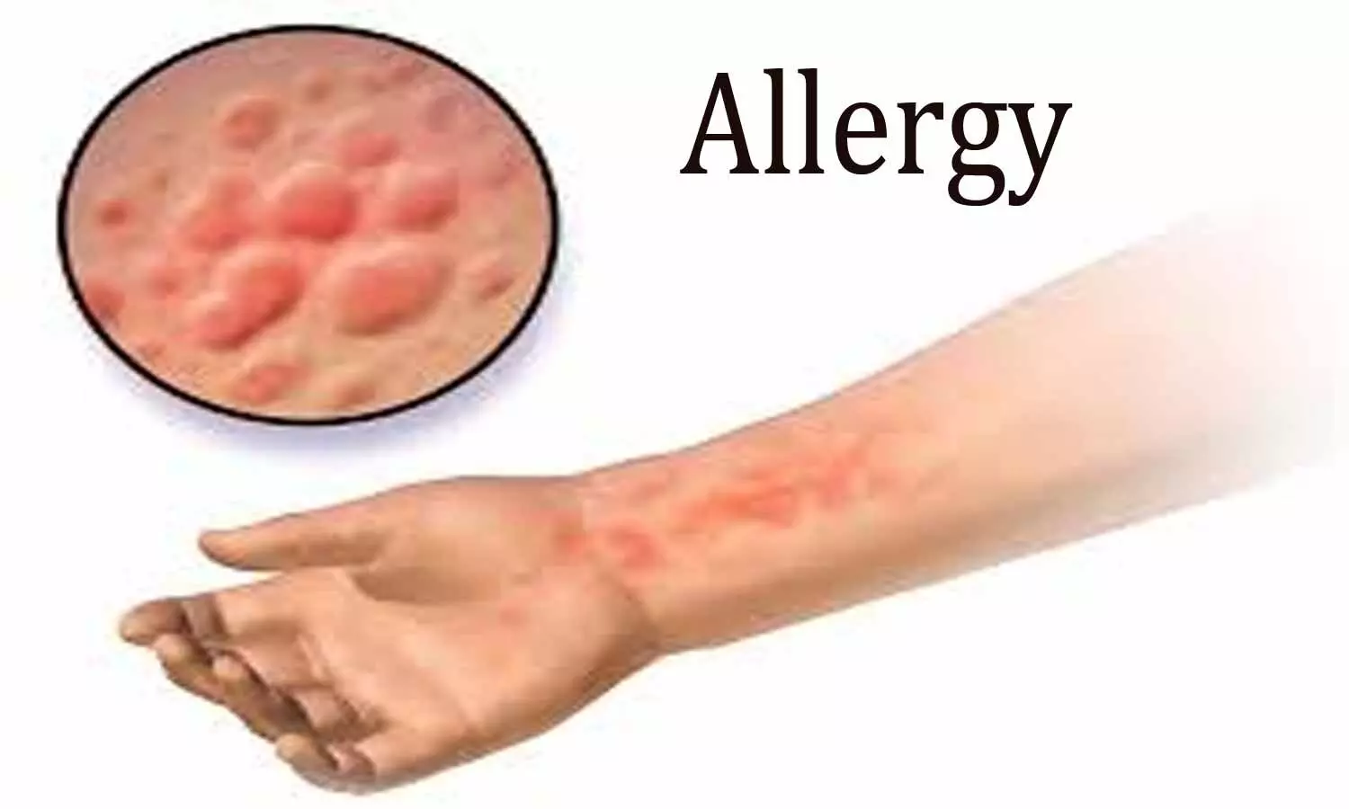 Mast cell assay- A novel painless and reliable allergy test