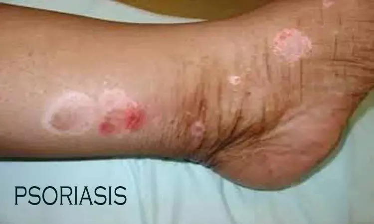 Use of some biologics increase risk of serious infections in psoriasis patients: JAMA