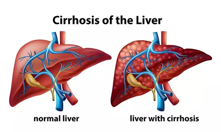 Why women are less likely to die of liver cirrhosis than men