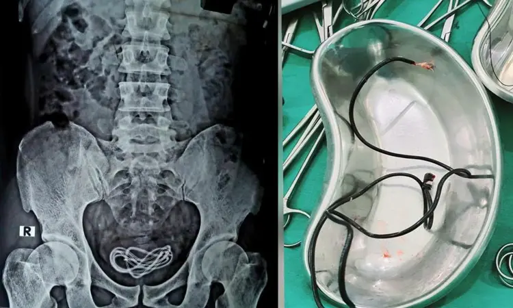 Bizarre! Mobile charger cord removed from mans urinary bladder