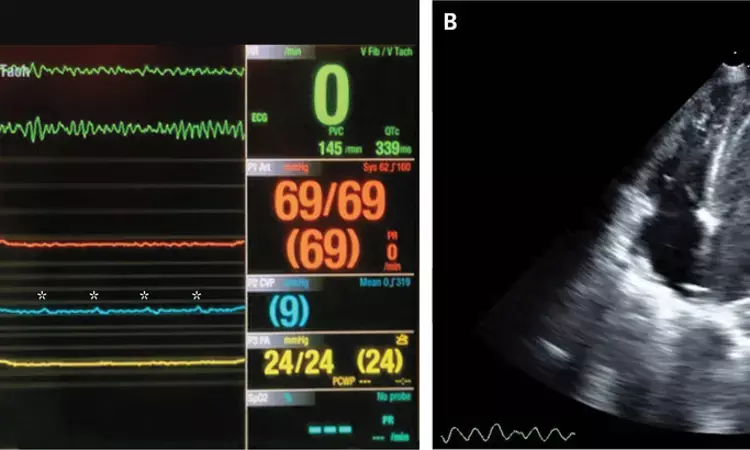 Case of AV dissociation during ventricular fibrillation reported in NEJM
