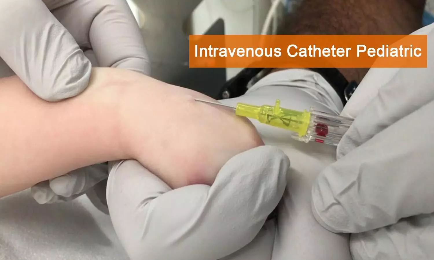 New Guidance for intravenous catheter selection in Pediatrics  released