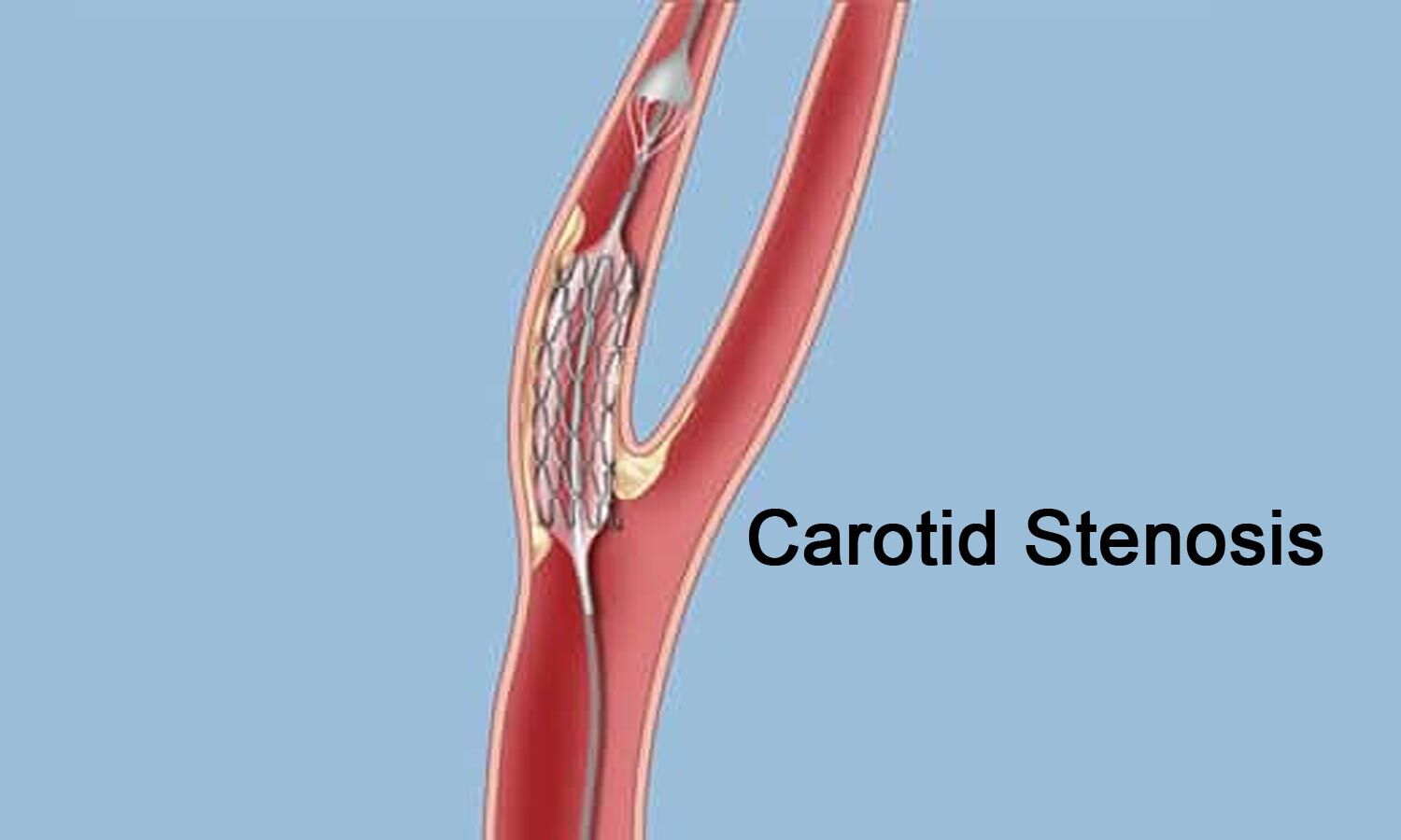 Carotid Stenosis Stroke Guidelines