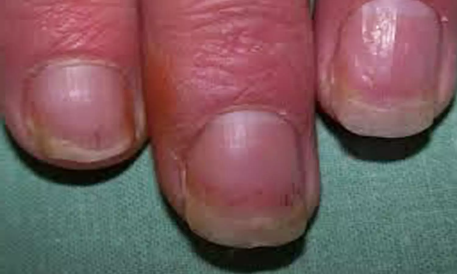 psoriasis nail changes dermnet)