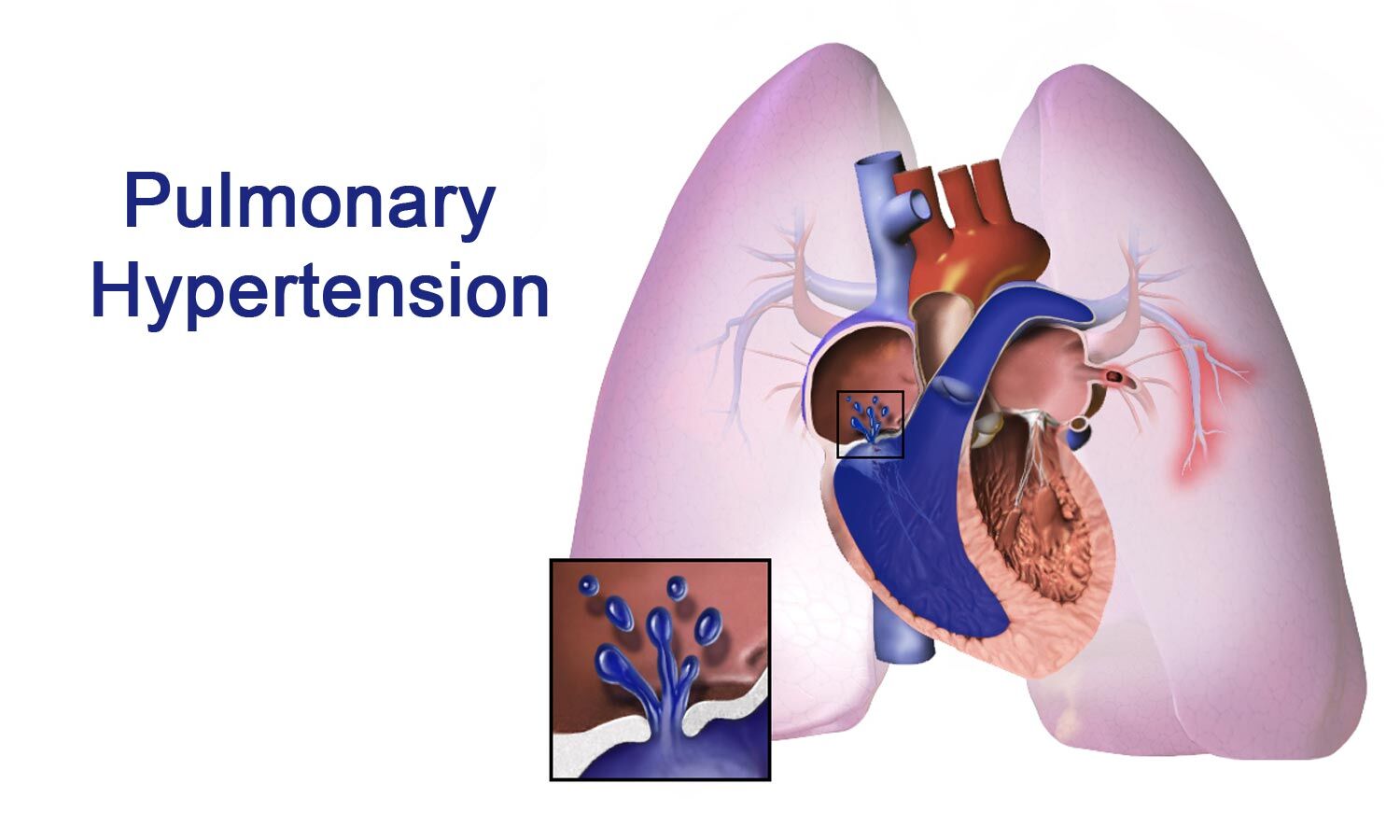 Легочное сердце рисунок. Pulmonary Hypertension, cor pulmonale. Pulmonary arterial Hypertension. Гипертензия легочной вены. Легочная артерия анатомия.