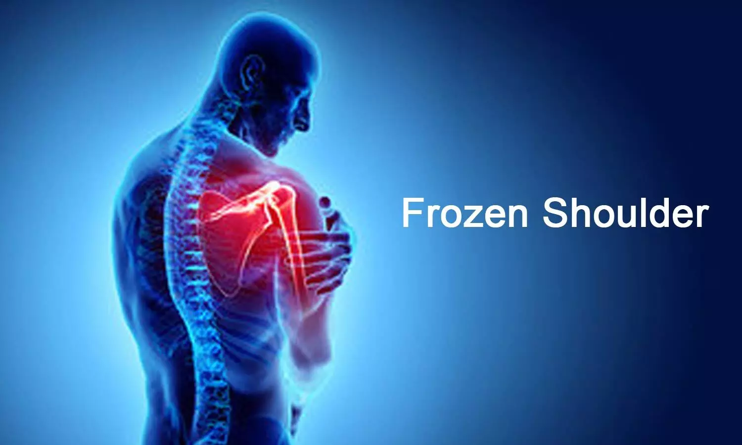 Corticosteroid plus exercise increases recovery in frozen shoulder patients: JAMA