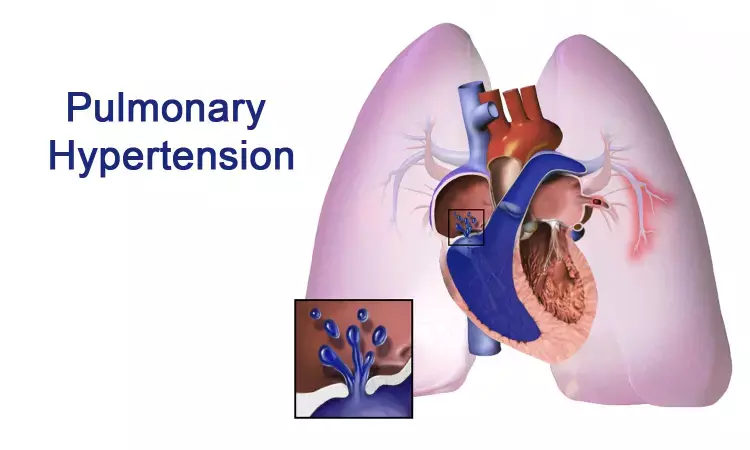 Potts shunt effective in children with suprasystemic pulmonary hypertension, Study reveals