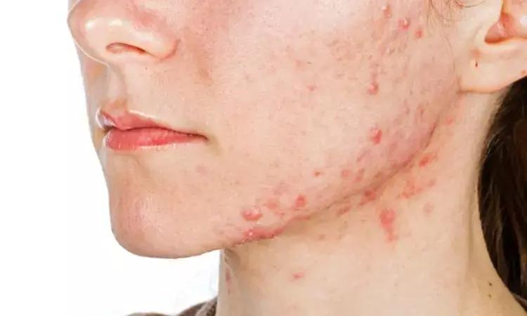 TNF inhibitors effective for treating refractory acne but also have potential to induce acne occurrence: JAMA