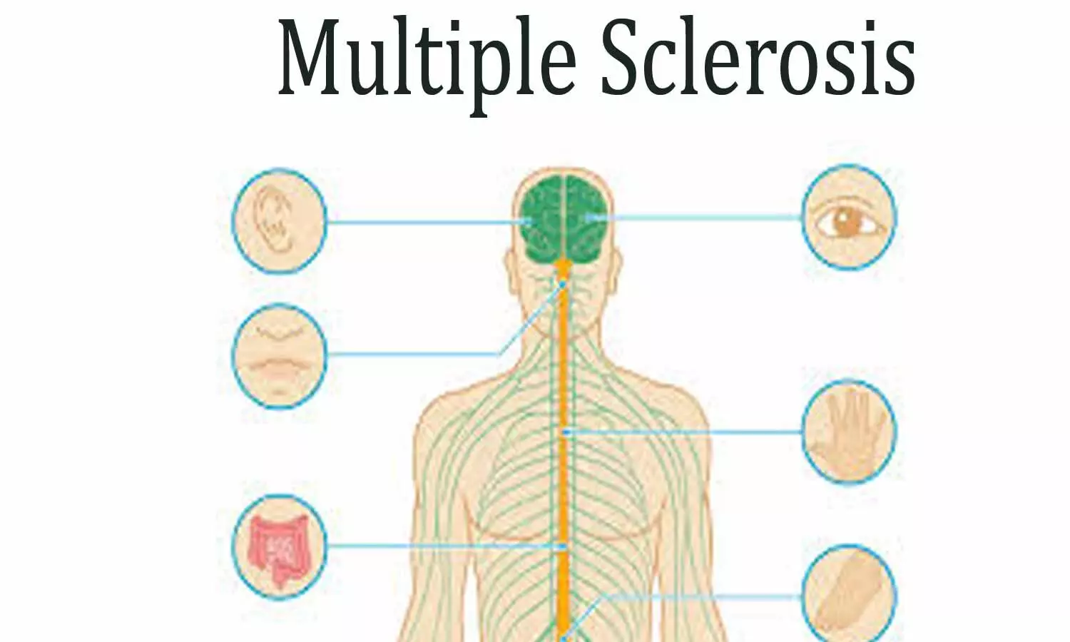 Teriflunomide may temper lesion growth in children with multiple sclerosis: Lancet