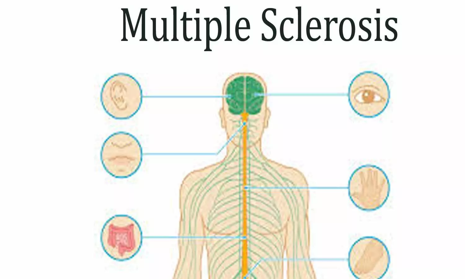 New MRI technique could improve diagnosis and treatment of multiple ...