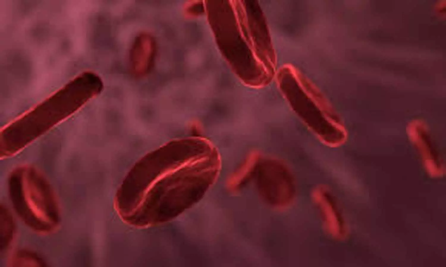 Vitamin D deficiency, low BMD linked to sickle cell anemia in children, finds study