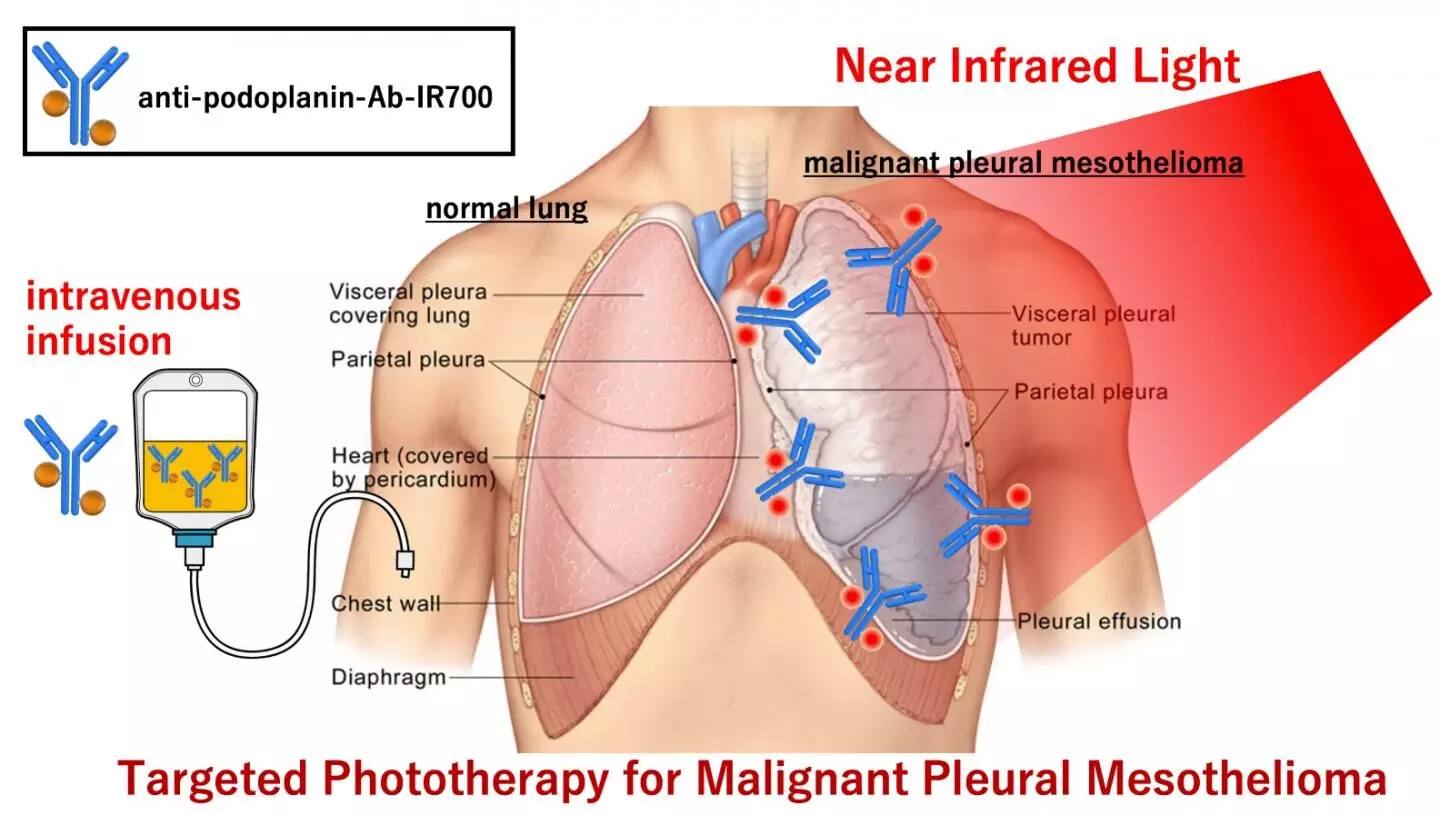 Near-infrared photoimmunotherapy new therapy for malignant lung cancer