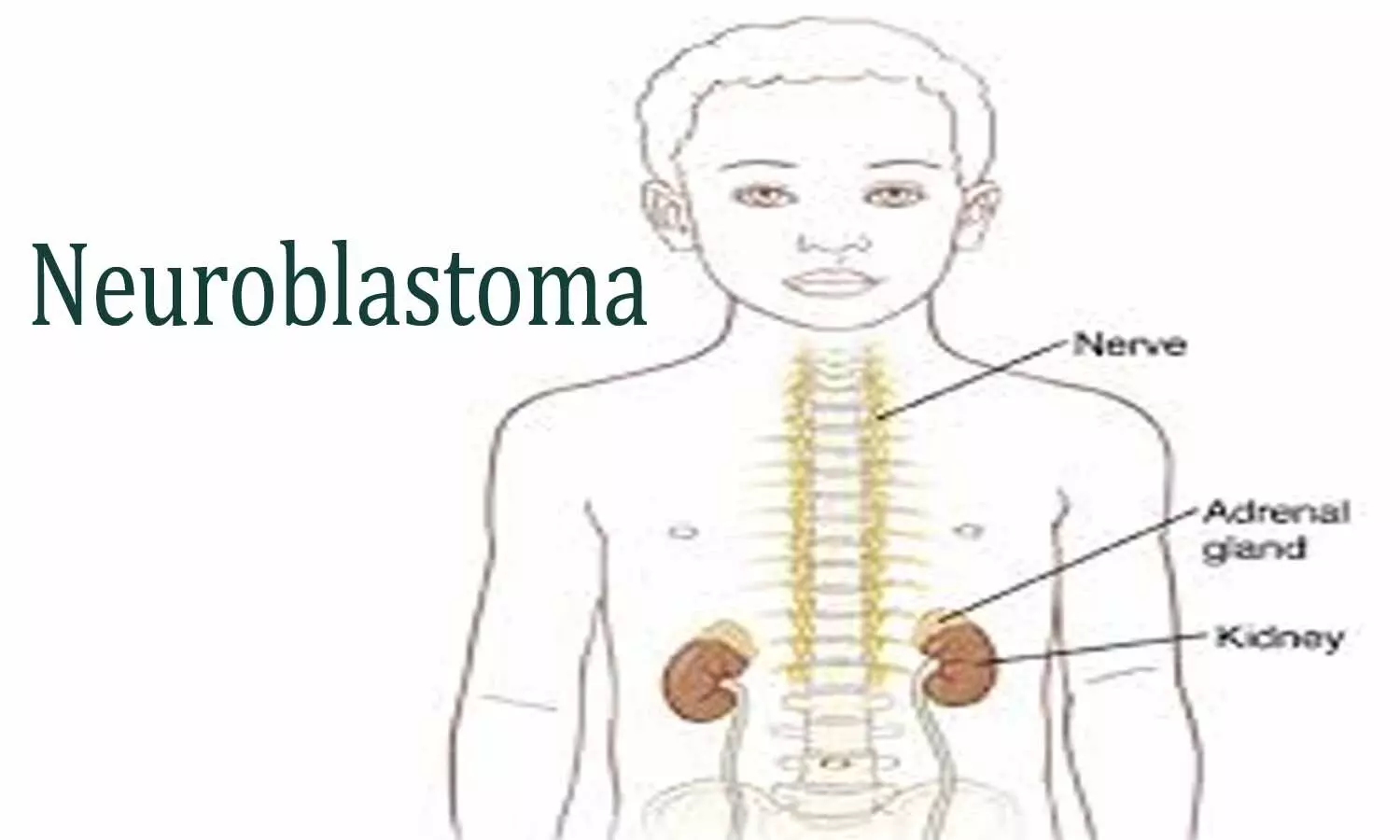 New radioisotope therapy improves survival in children with neuroblastoma