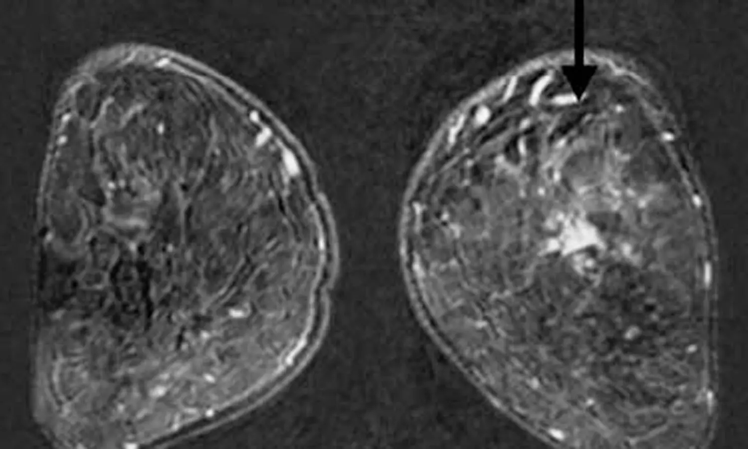 Pre-operative MRI may identify additional breast cancer sites for better management