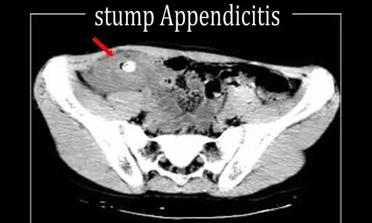 Case of stump appendicitis two years after first laparoscopic appendectomy : A Report