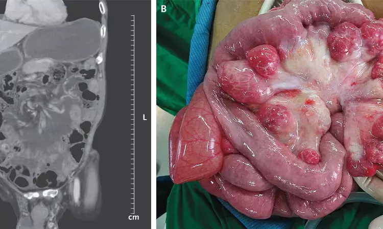 Case of Mesenteric Volvulus from Jejunal Diverticulosis reported in NEJM