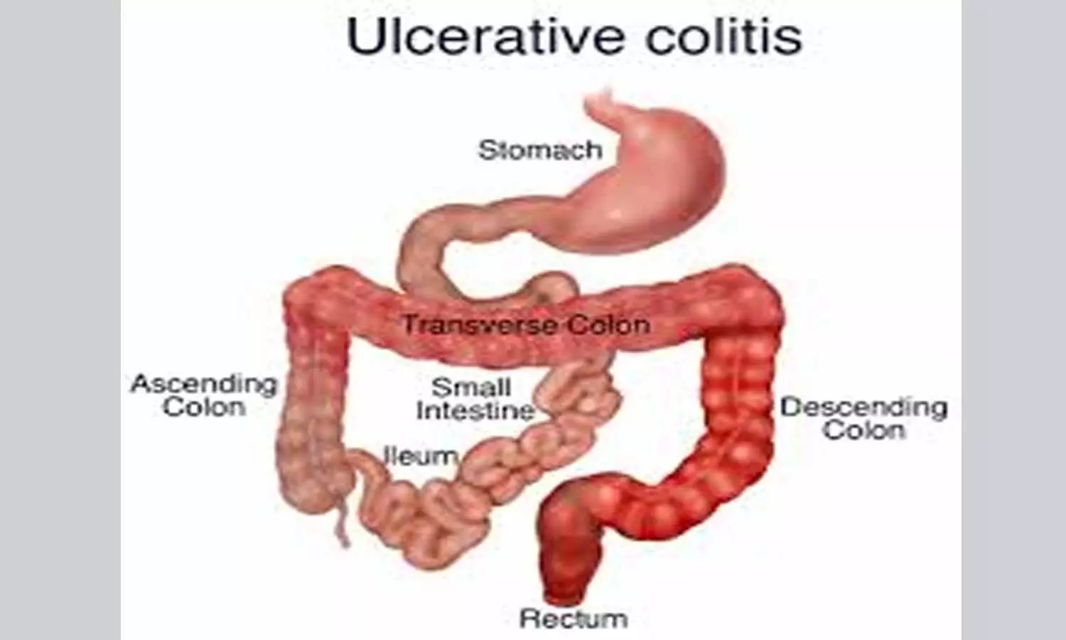 Intestinal ultrasound preferred option to monitor ulcerative colitis course: Study