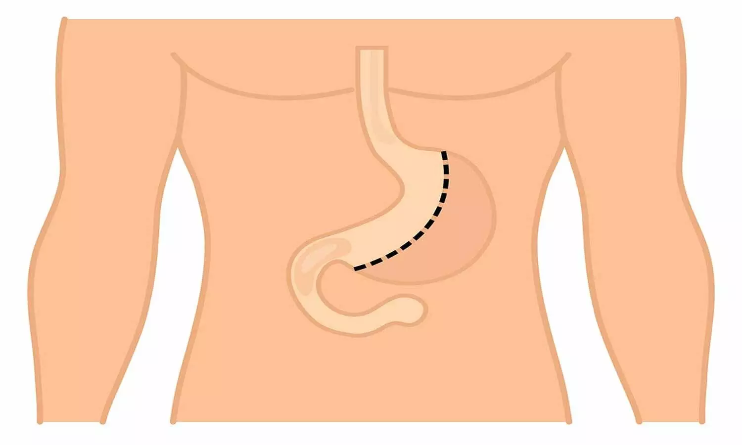 Comparison of long-term weight loss between sleeve gastrectomy and sleeve  gastrectomy with jejunal bypass - Surgery for Obesity and Related Diseases