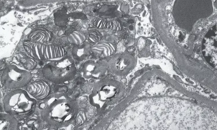 Case of Fabrys disease with zebra bodies in kidney reported in NEJM