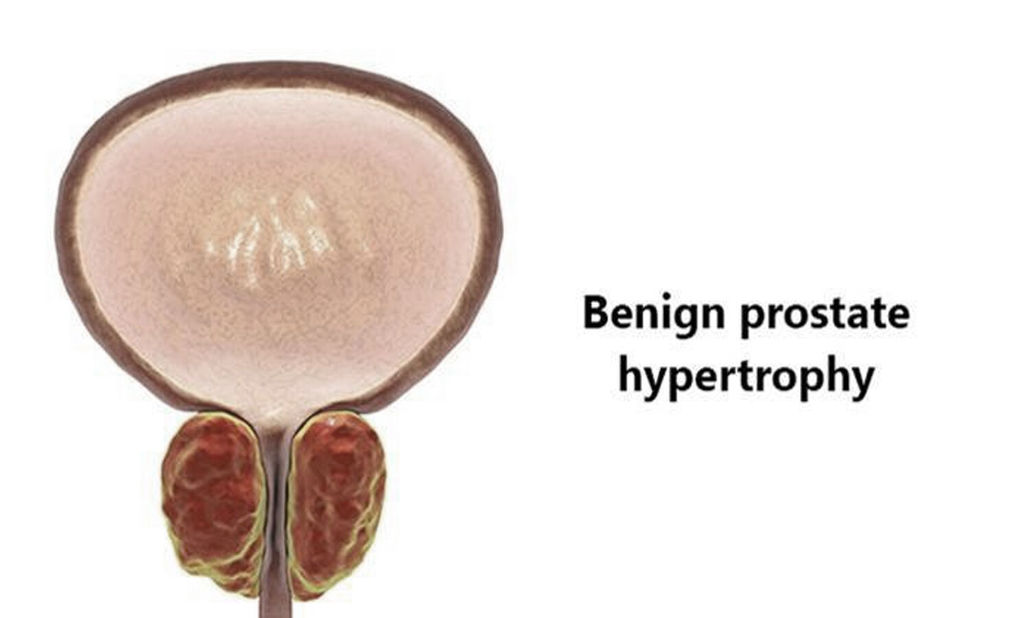 Surgical Management of Lower Urinary Tract Symptoms due BPH AUA guidelines