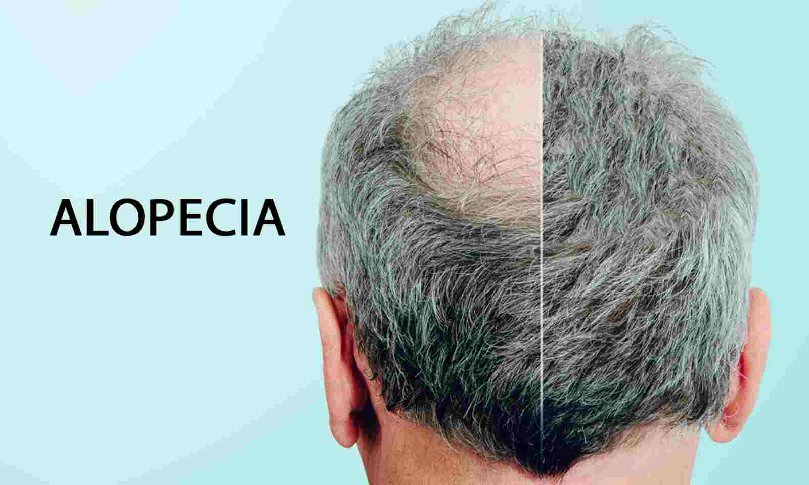 Low dose Oral Minoxidil Safe for Non-scarring Alopecia, finds study