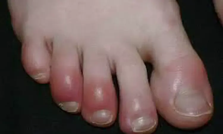 Study Supports Link Between COVID-19 and COVID Toes