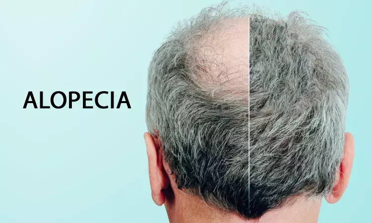 Baricitinib shows promise in treating Alopecia areata,finds study