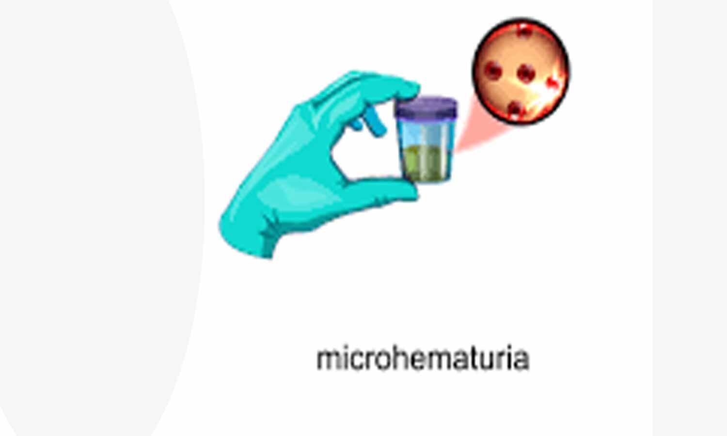Management of microhematuria: AUA/SUFU guidelines