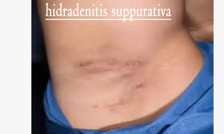 Dapsone effective treatment of severe hidradenitis suppurativa