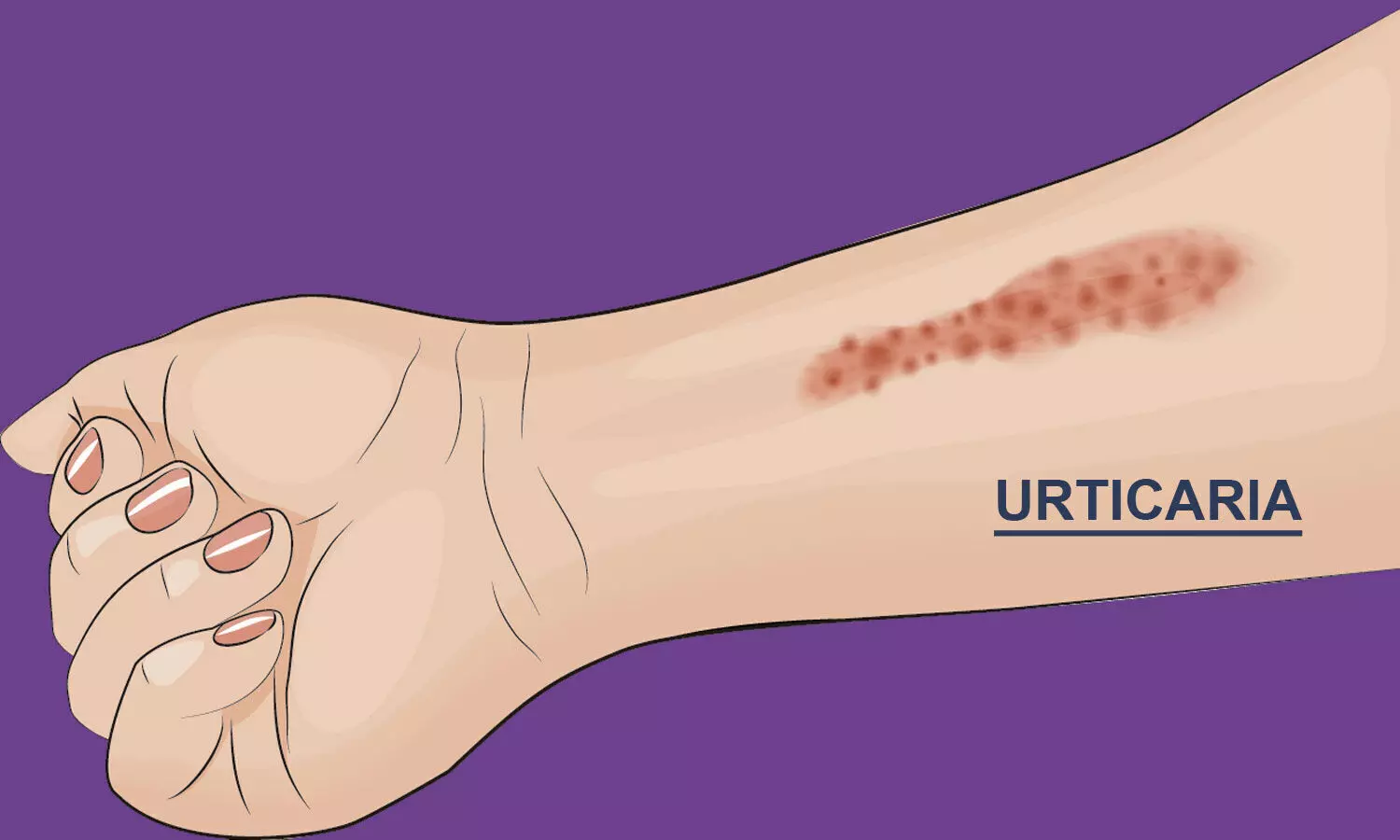 Case Of Metformin Induced Urticaria In Type 2 Diabetes Reported