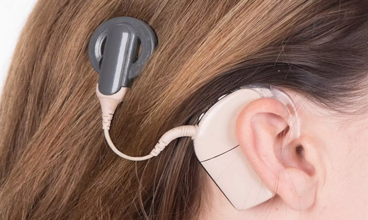 Bad hearing. Кохлеарный имплант кохлеар. Кохлеарная имплантация Oticon. Аппарат Cochlear кохлеарный. Слуховой процессор Кохлер.