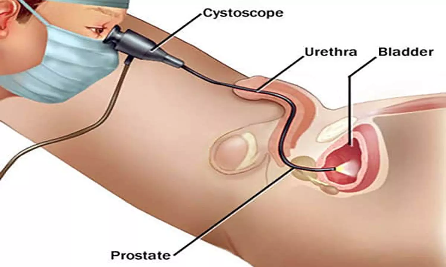 Is it useful to perform biopsy at flexible cystoscopy? Study throws light