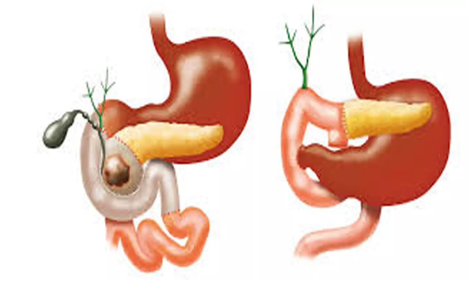 Avoiding nasogastric decompression safe after pancreaticoduodenectomy: JAMA