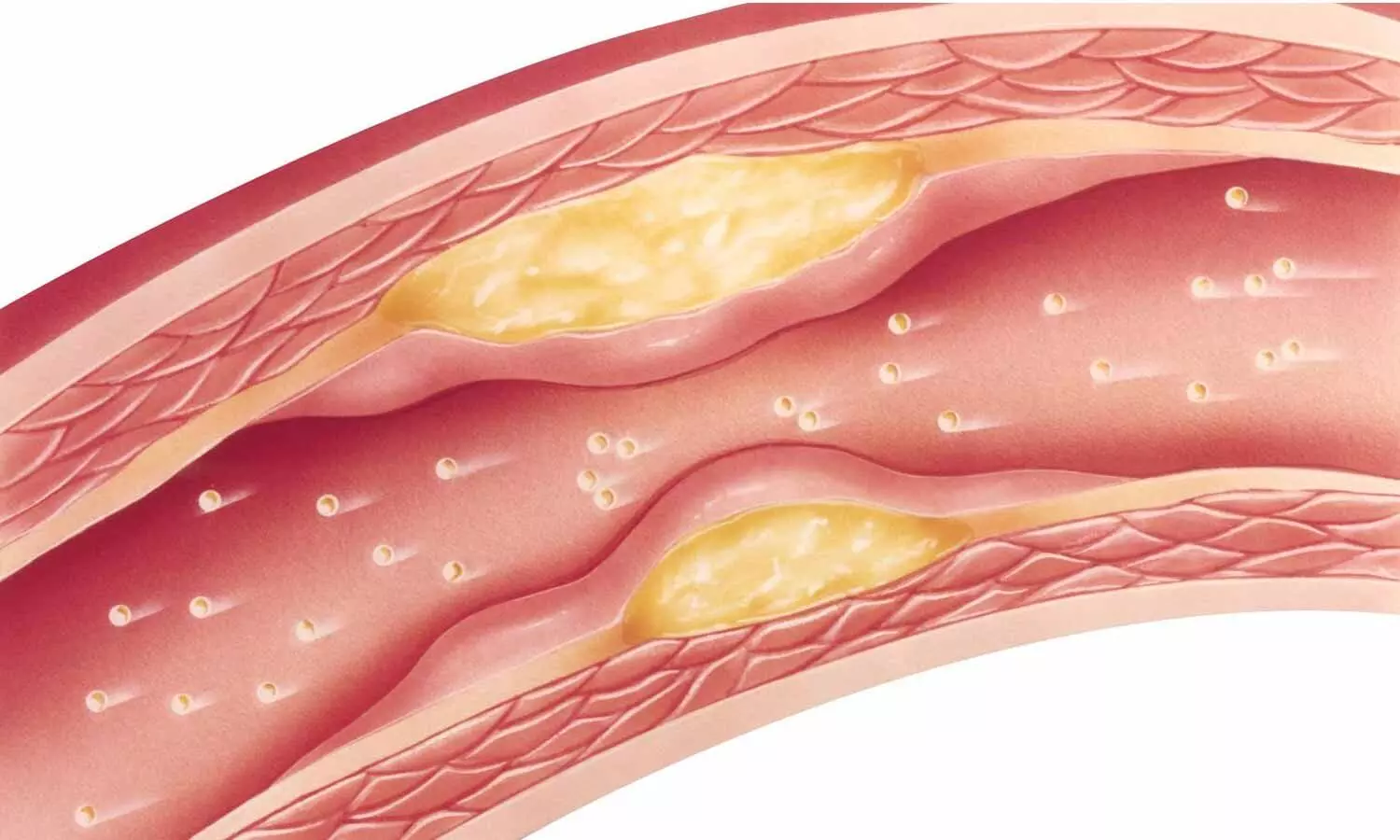 На фоне фиброзных изменений. Атеросклероз фиброзные бляшки. Атеросклерозная бляшка сосуда. Атеросклеротический кардиосклероз. Холестериновые бляшки в сосудах.