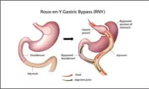 Men more prone to major postoperative complications after bariatric surgery, finds study