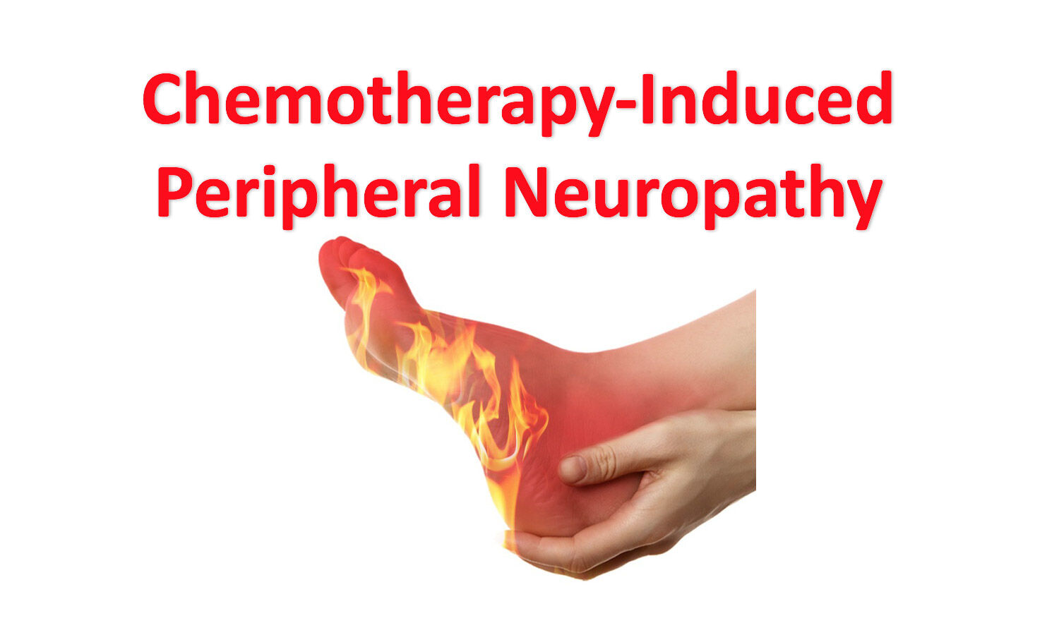 Managing ChemotherapyInduced Peripheral Neuropathy in