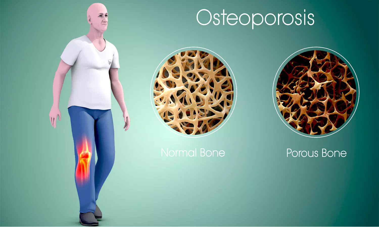 Laser irradiation may be promising treatment modality for osteoporosis